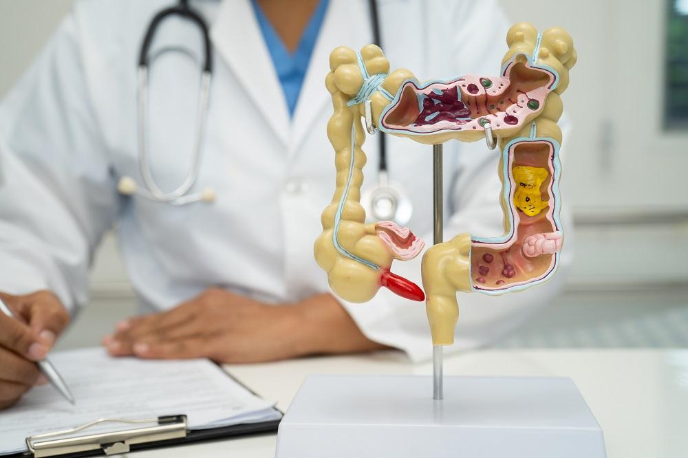 Colon and Rectal Cancer - Overview, Causes, and Treatments