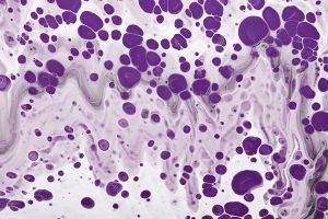 Sentinel Lymph Node Biopsy: Procedure, Risks, and Benefits