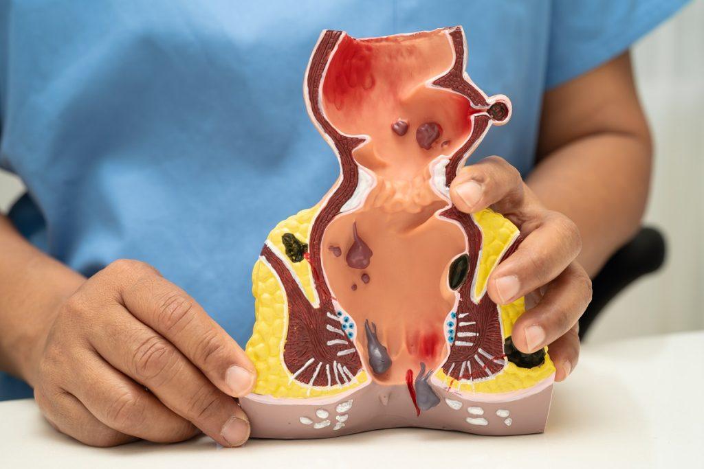 Pilonidal Disease: Overview, Causes, Symptoms, and Treatment Options